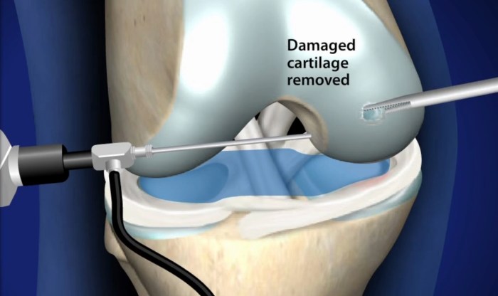 Chondroplasty is the surgical repair of damaged cartilage