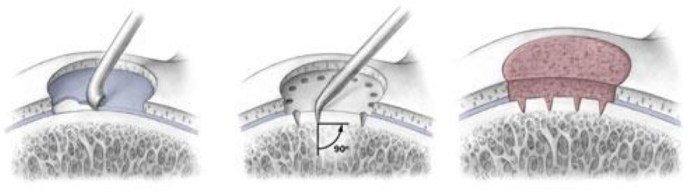 Cartilage joint preservation knee edges moves catch when may au